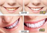 洗牙一次大概多少钱,一次洗牙价格全览