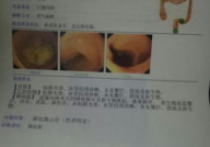 什么是腺癌,腺癌的病理机制与临床特征概述