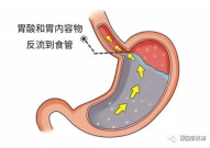 胃食管反流病中医能看吗,中医视角下的胃食管反流病诊疗概览